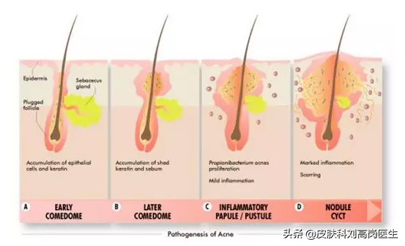 常见11种皮肤病讲解之「痤疮-最有效的几种治疗方法」