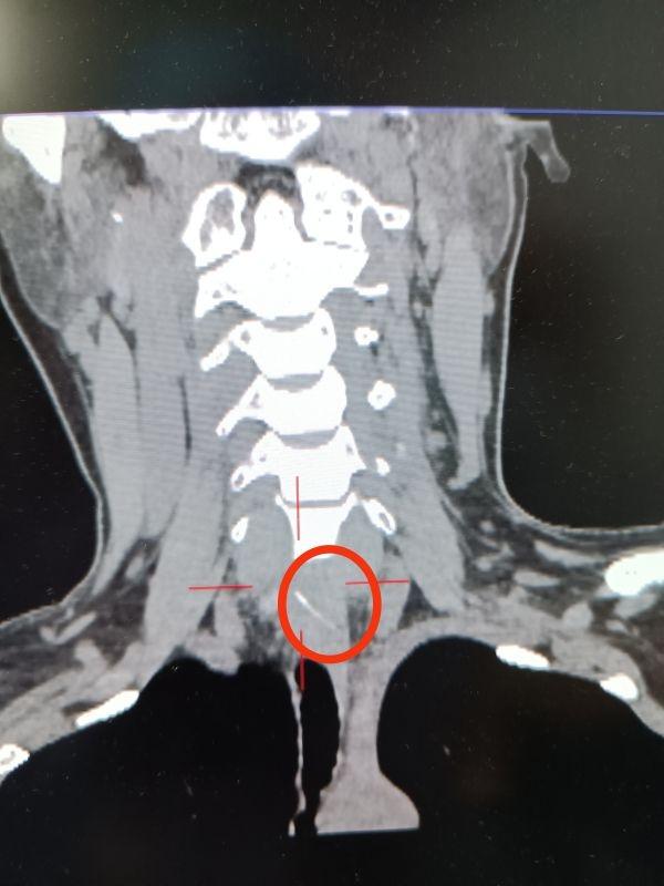 “鱼刺卡着了？吞口饭就下去了吧！”结果鱼刺进了食道