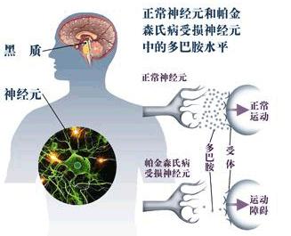 帕金森病能被治愈吗？