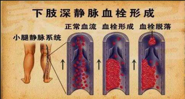 胸痛小心是由于肺动脉血栓栓塞导致