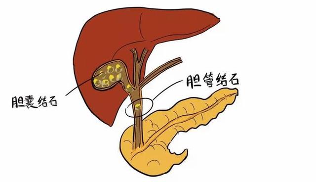 4种用于胆结石、胆囊炎、口苦的中成药，建议收藏