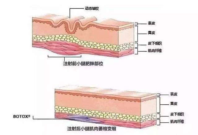 注射瘦腿针你也一定有这些疑问吧，这里都是答案