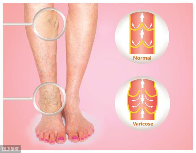 长期久站，竟差点截肢！医生：静脉栓塞了很严重，别不当一回事