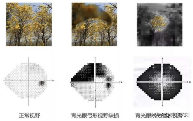 健康科普堂 | 您了解“视野”吗？